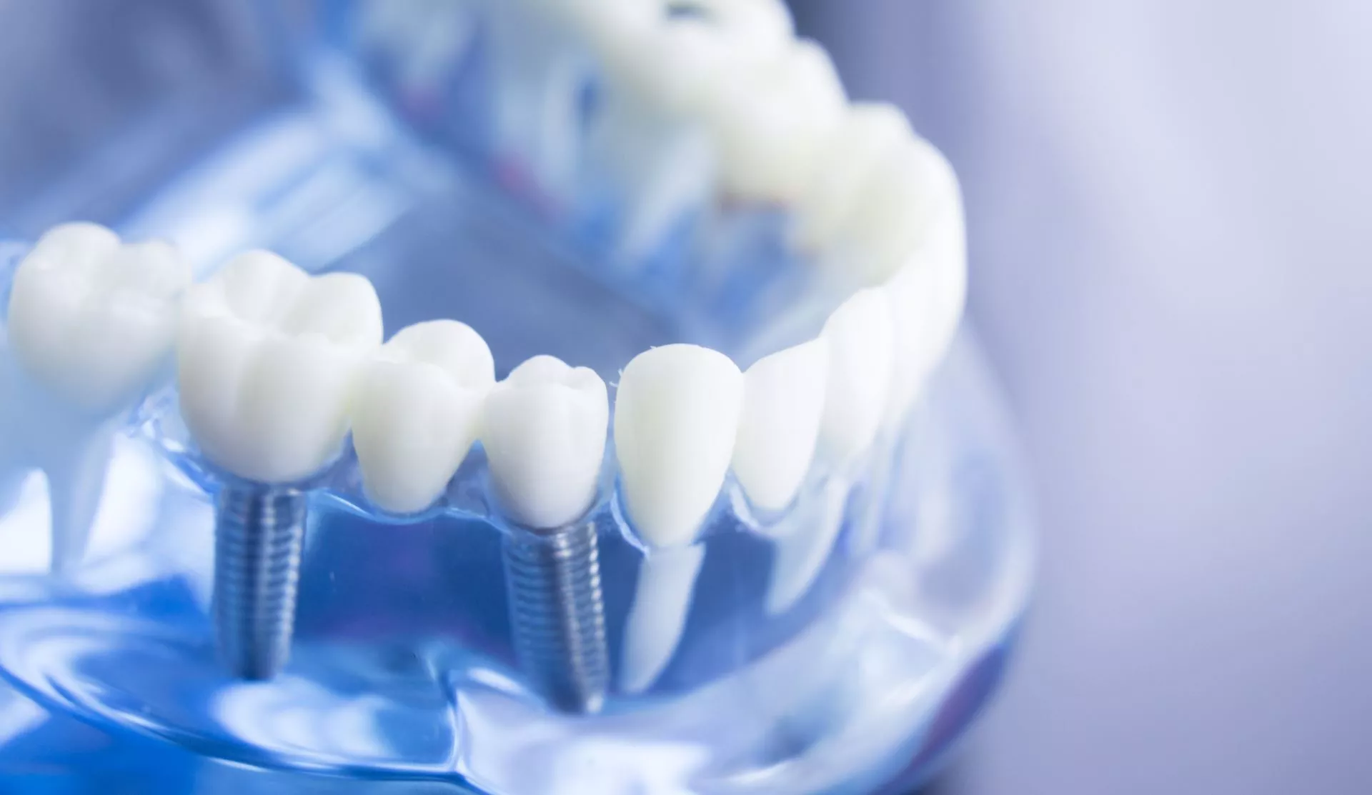 Cheap & Affordable Dental Implants