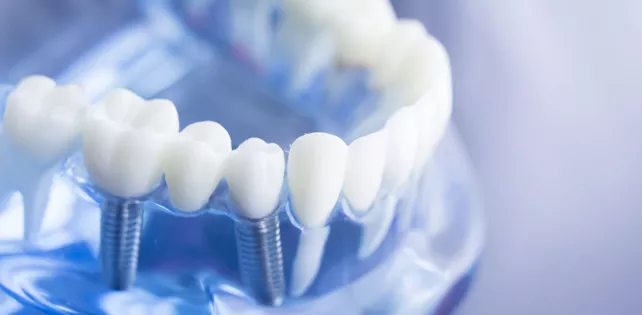Cheap & Affordable Dental Implants