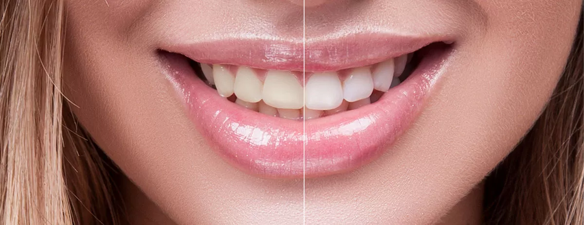 Tooth Whitening