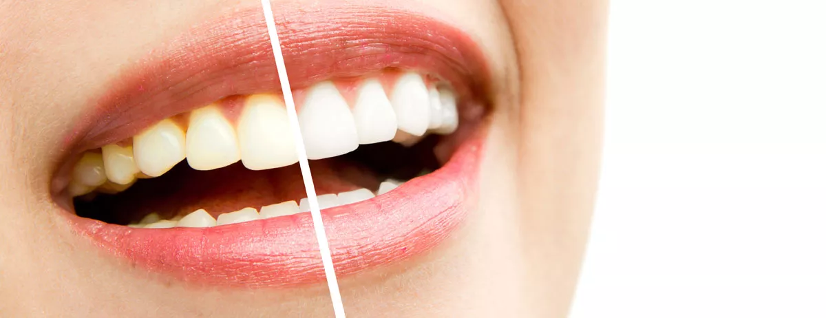 Does Teeth Whitening Damage Teeth? 