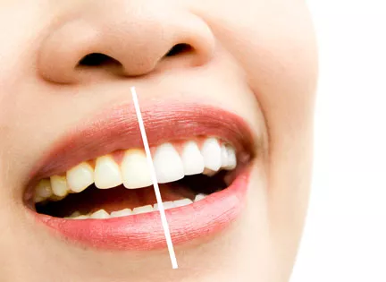 Does Teeth Whitening Damage Teeth? 