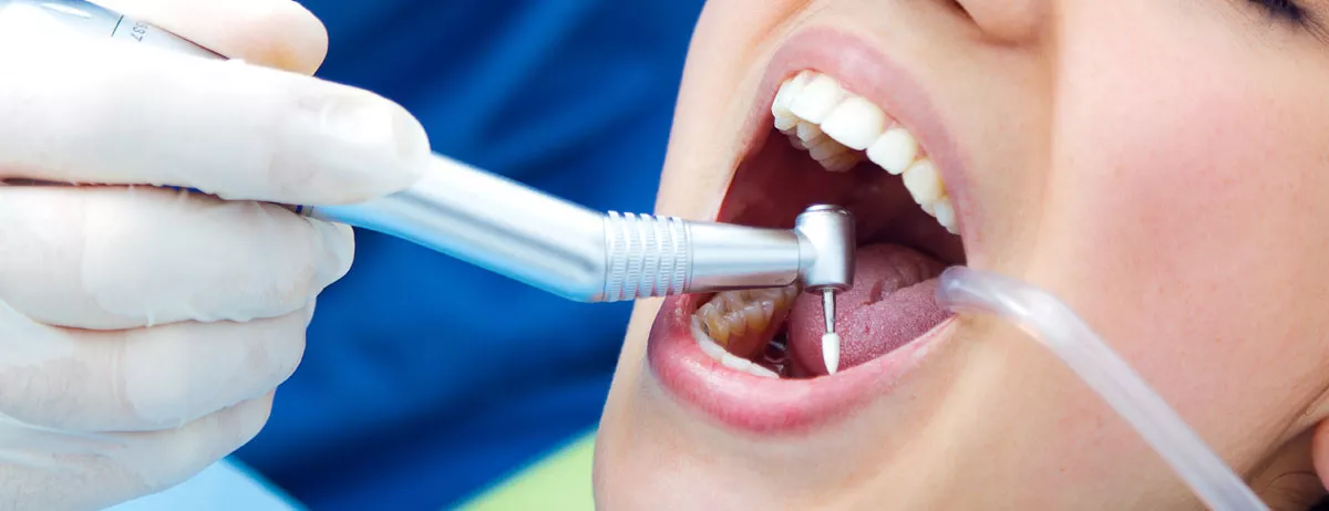 Does Tartar Cleaning Damage Teeth? 