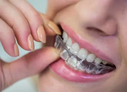 Orthodontic Treatment with Transparent Plates