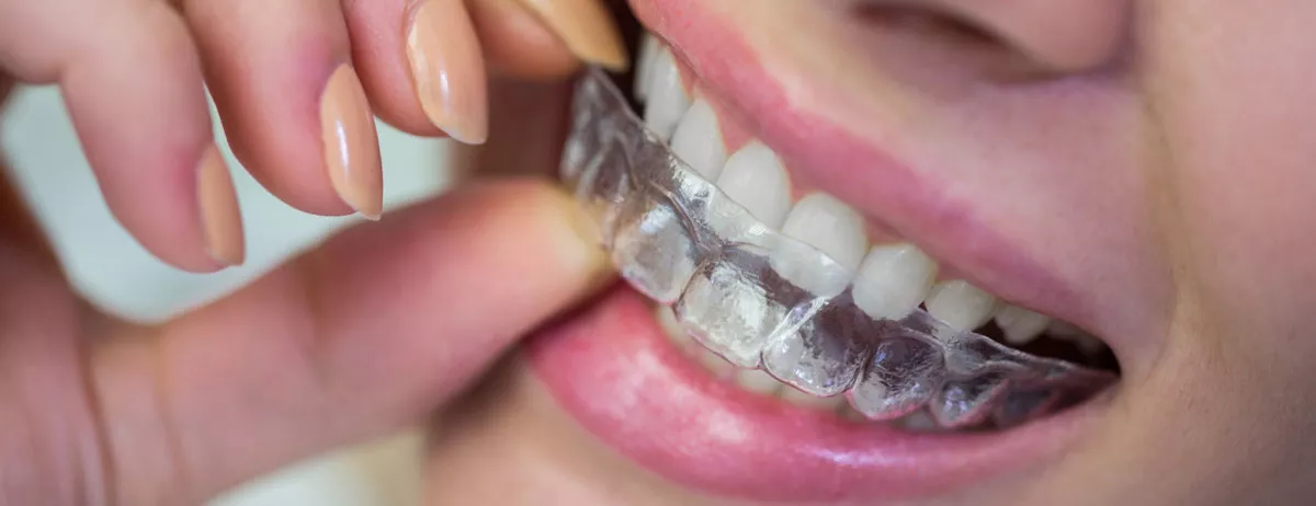 Orthodontic Treatment with Transparent Plates