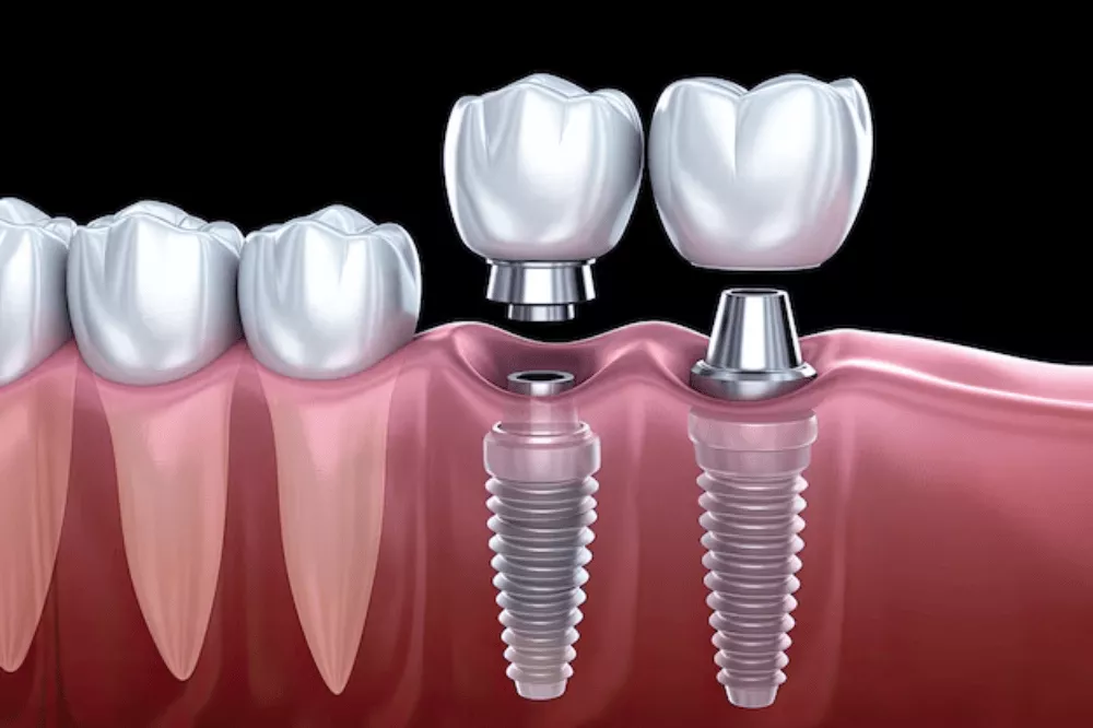 Cheap & Affordable Dental Implants
